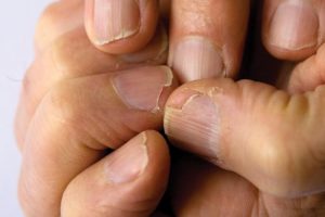 Uñas quebradizas