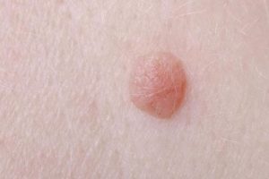 Consejos naturales para eliminar las verrugas