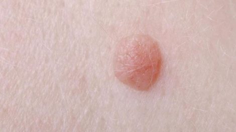 Consejos naturales para eliminar las verrugas