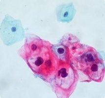 Sexo oral y cancer de garganta